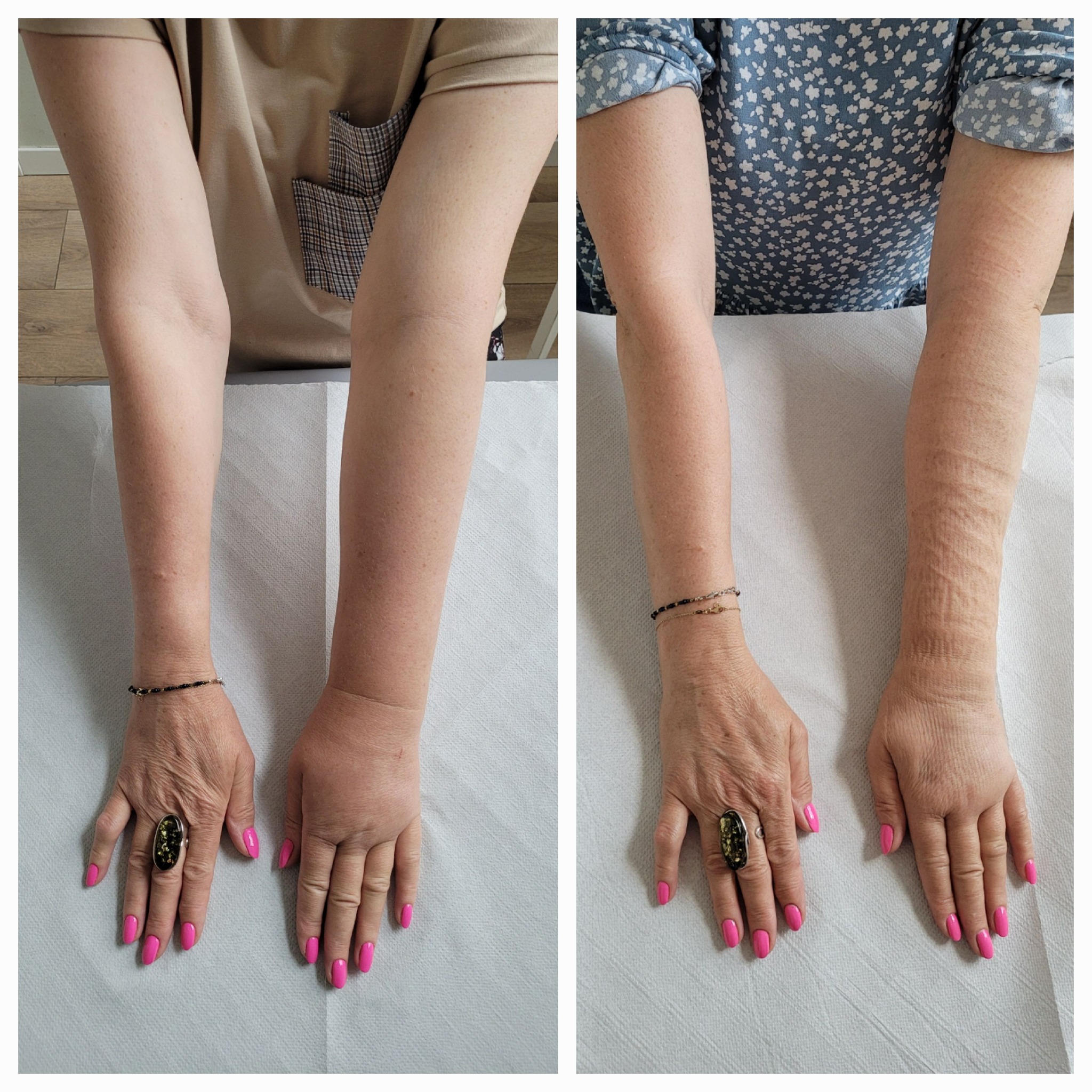 terapia obrzęków Evital Rehabilitacja Warszawa